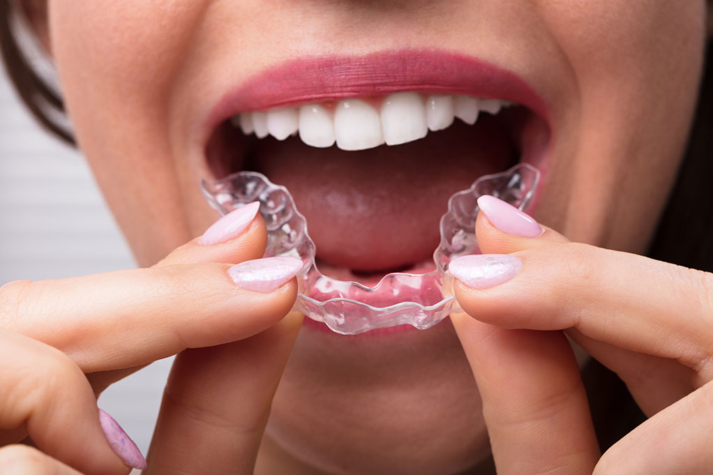 Invisalign Clinica Dental Ortigosa