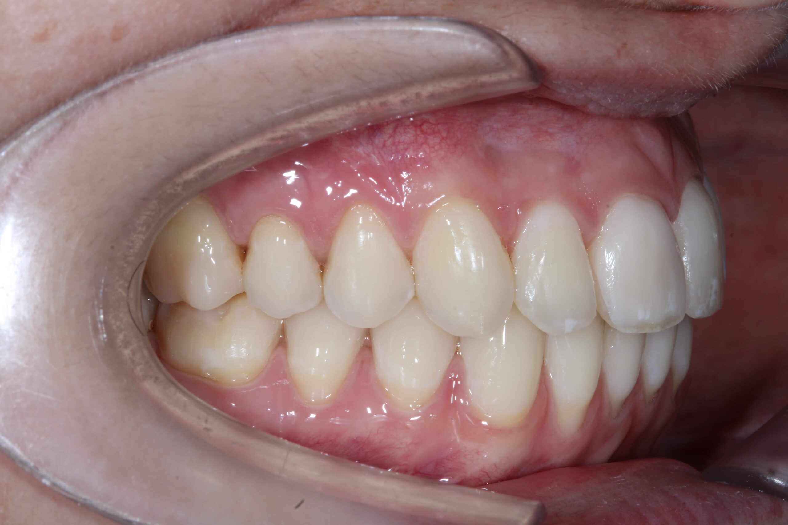 DESPUES CIRUGIA PROGNATISMO MANDIBULAR (1)